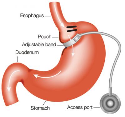 we are oﬀering the Hypnotic Gastric Lap band 5 week program for the amazing price of $550