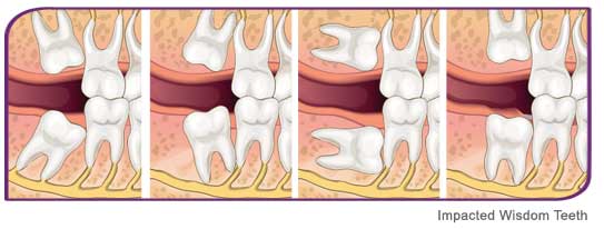 Wisdom Teeth Removal And Extraction – Healthy Smiles